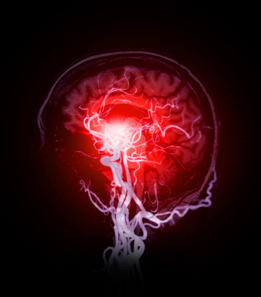 Esta Imagen combinada de resonancia magnética cerebral y arteria cerebral proporciona una visión integral del cerebro